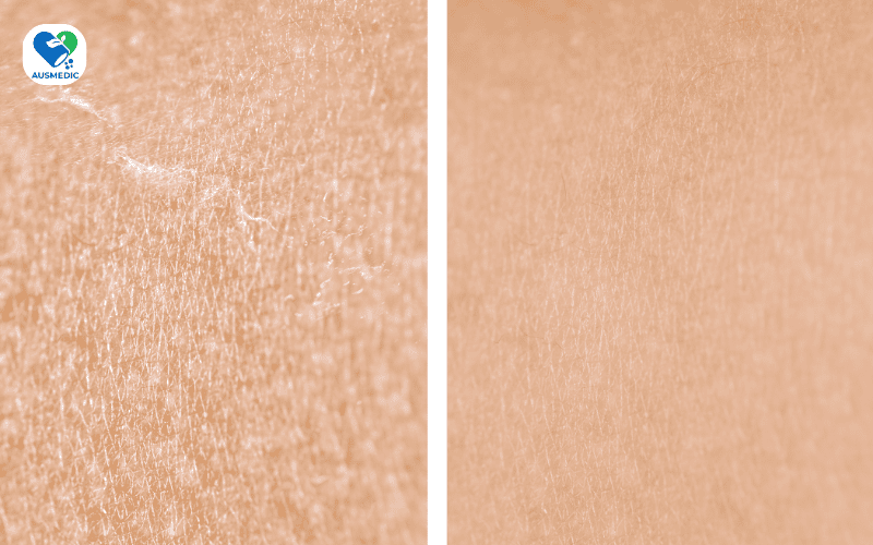 Da Mất Nước Mùa Hè: Dấu Hiệu Nhận Biết Và 7 Bước Phục Hồi Cấp Tốc