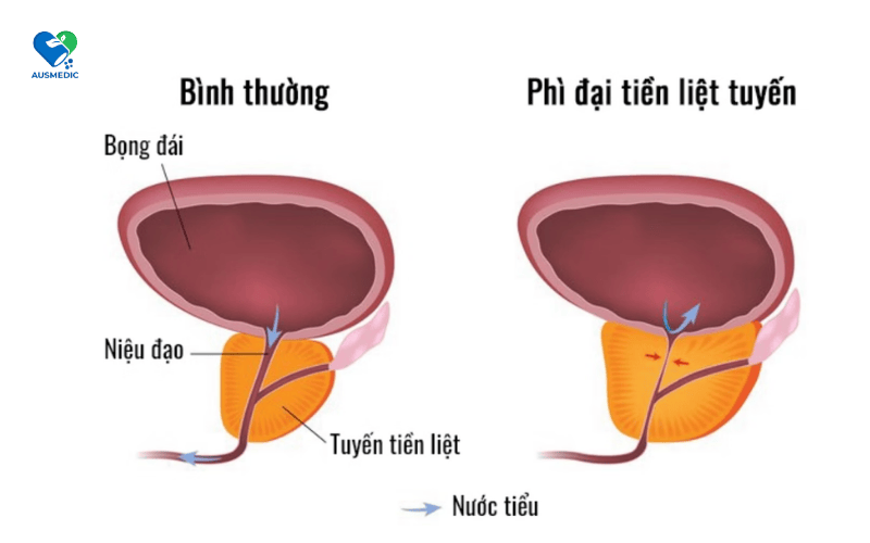 NEST STRONG: "CỨU CÁNH" CHO CEO PHÌ ĐẠI TUYẾN TIỀN LIỆT! 