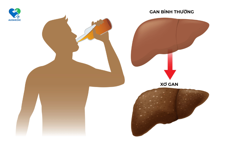 Hạn chế rượu bia để bảo vệ sức khoẻ: Lời khuyên phục hồi từ chuyên gia
